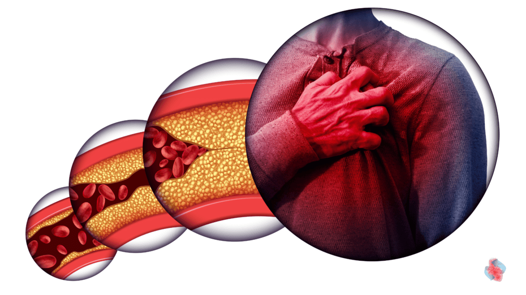 Doenças cardíacas e risco de infarto